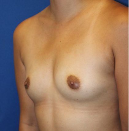 Breast Augmentation Before & After Patient #4784