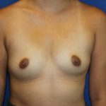 Breast Augmentation Before & After Patient #4784