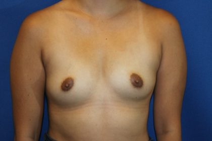 Breast Augmentation Before & After Patient #4784