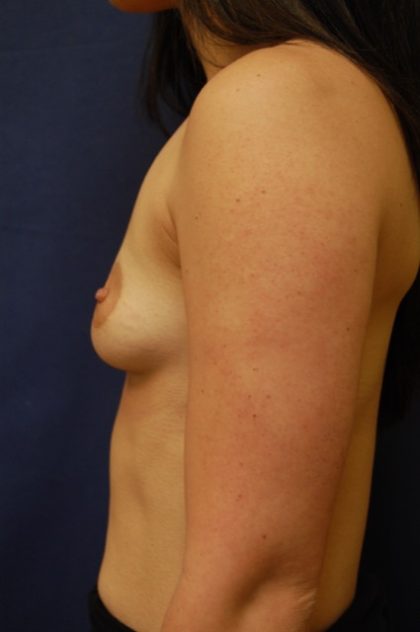 Breast Augmentation Before & After Patient #3594