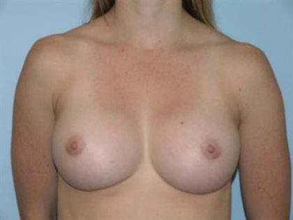 Breast Augmentation Before & After Patient #4752