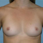 Breast Augmentation Before & After Patient #4752