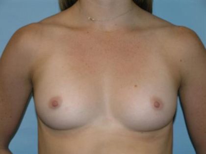 Breast Augmentation Before & After Patient #4752