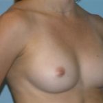 Breast Augmentation Before & After Patient #4752