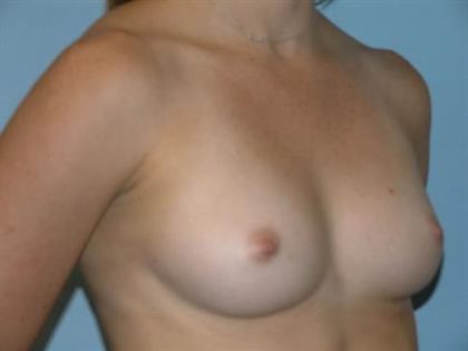 Breast Augmentation Before & After Patient #4752