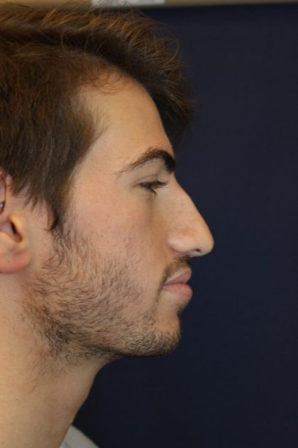 Rhinoplasty Before & After Patient #4214