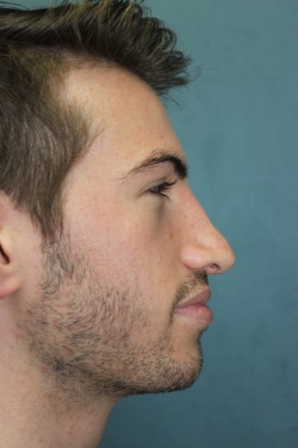 Rhinoplasty Before & After Patient #4214