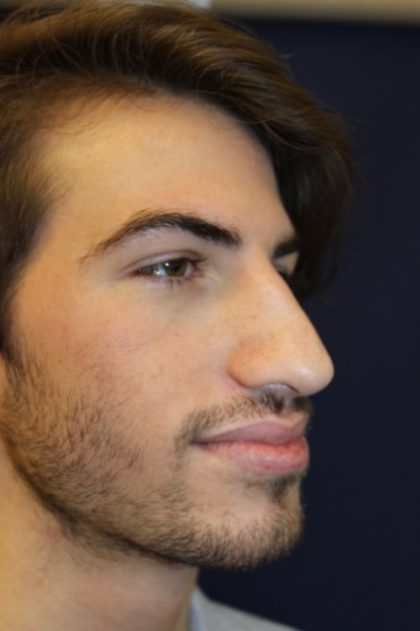 Rhinoplasty Before & After Patient #4214