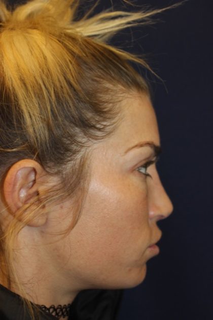 Rhinoplasty Before & After Patient #4227