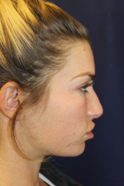 Rhinoplasty Before & After Patient #4227