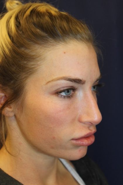 Rhinoplasty Before & After Patient #4227
