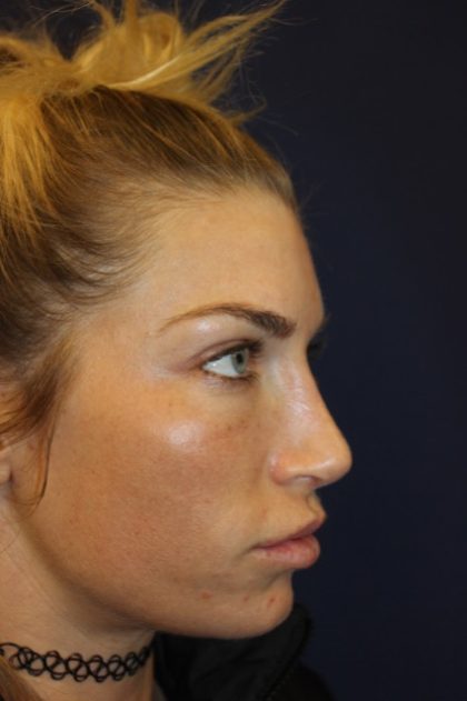 Rhinoplasty Before & After Patient #4227