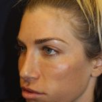 Rhinoplasty Before & After Patient #4227