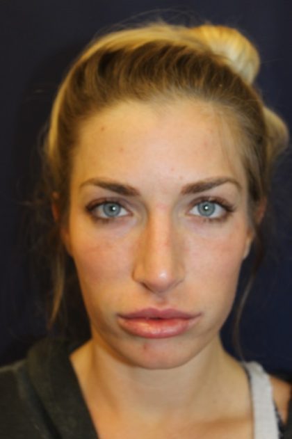 Revision Rhinoplasty Before & After Patient #4227