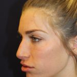 Rhinoplasty Before & After Patient #4227