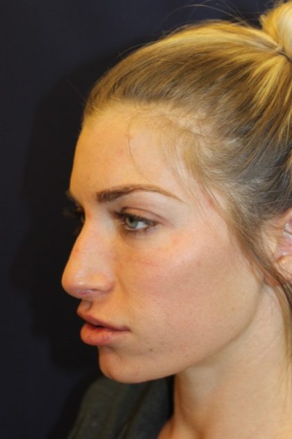 Rhinoplasty Before & After Patient #4227