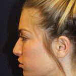 Rhinoplasty Before & After Patient #4227