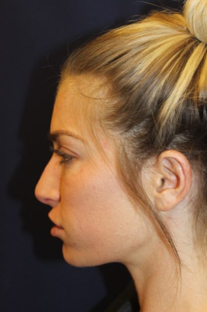 Rhinoplasty Before & After Patient #4227