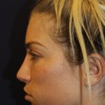 Rhinoplasty Before & After Patient #4227