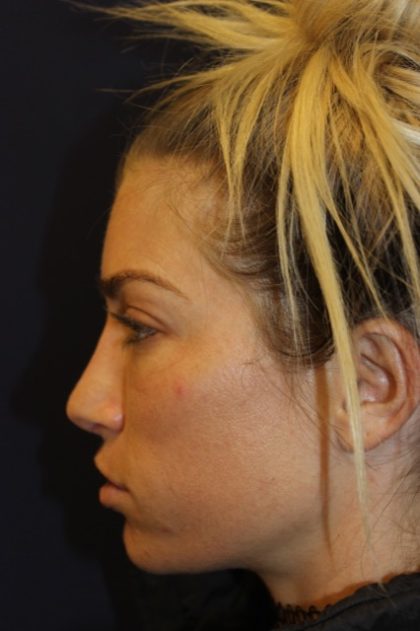 Rhinoplasty Before & After Patient #4227