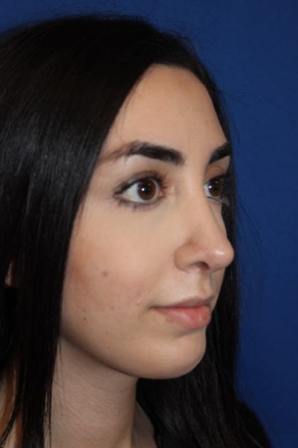 Rhinoplasty Before & After Patient #4257