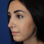 Rhinoplasty Before & After Patient #4257