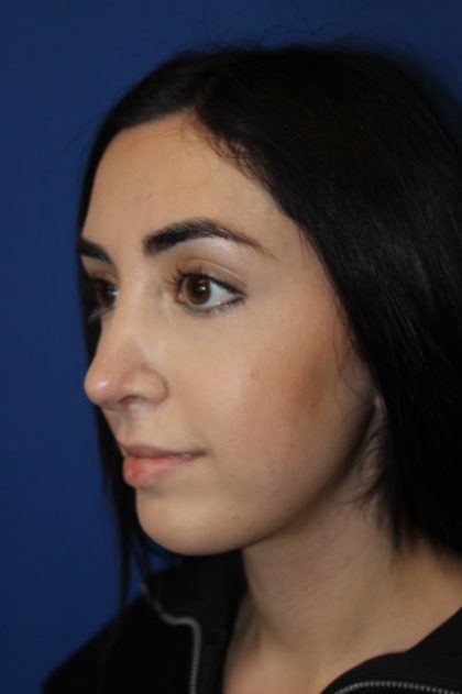 Rhinoplasty Before & After Patient #4257