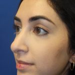 Rhinoplasty Before & After Patient #4257