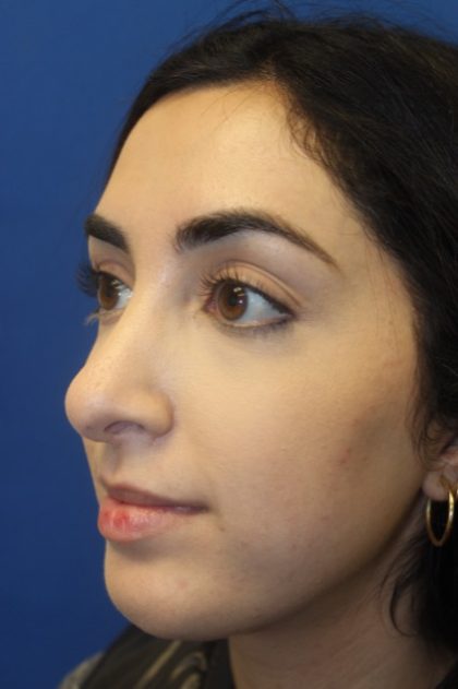 Rhinoplasty Before & After Patient #4257