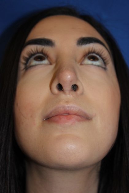 Rhinoplasty Before & After Patient #4257