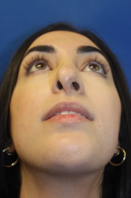 Rhinoplasty Before & After Patient #4257