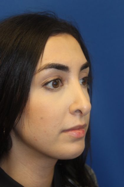 Rhinoplasty Before & After Patient #4257