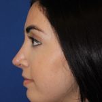 Rhinoplasty Before & After Patient #4257