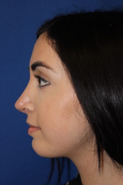 Rhinoplasty Before & After Patient #4257