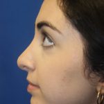 Rhinoplasty Before & After Patient #4257