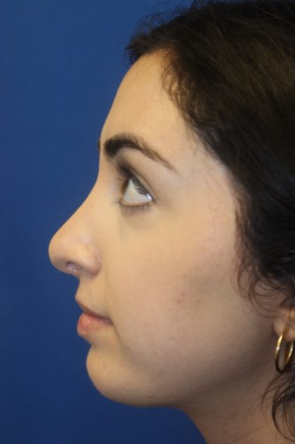 Rhinoplasty Before & After Patient #4257