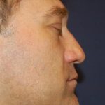 Rhinoplasty Before & After Patient #4209