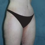 Tummy Tuck Before & After Patient #4170