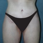 Tummy Tuck Before & After Patient #4170