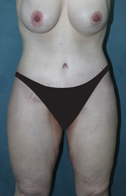 Tummy Tuck Before & After Patient #4170