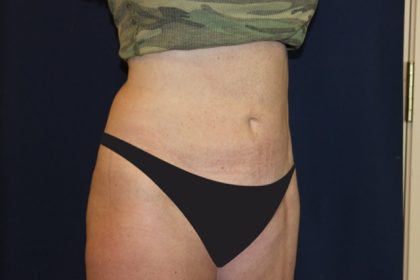 Tummy Tuck Before & After Patient #4192