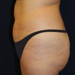 Tummy Tuck Before & After Patient #4192