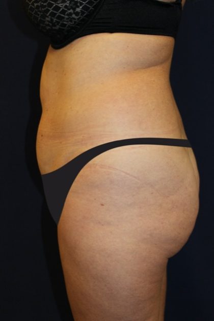 Tummy Tuck Before & After Patient #4192