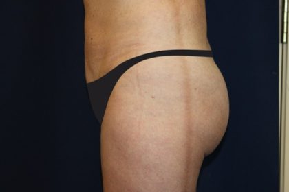 Tummy Tuck Before & After Patient #4192