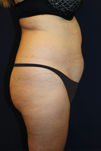 Tummy Tuck Before & After Patient #4192