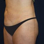 Tummy Tuck Before & After Patient #4192