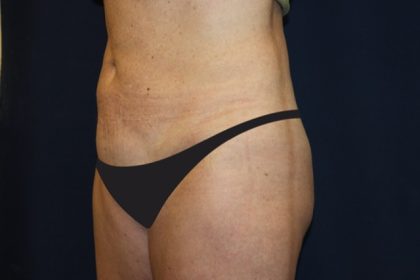 Tummy Tuck Before & After Patient #4192