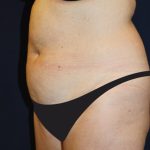 Tummy Tuck Before & After Patient #4192