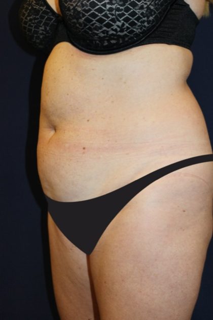 Tummy Tuck Before & After Patient #4192