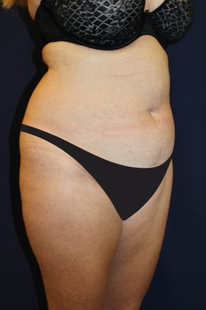 Tummy Tuck Before & After Patient #4192